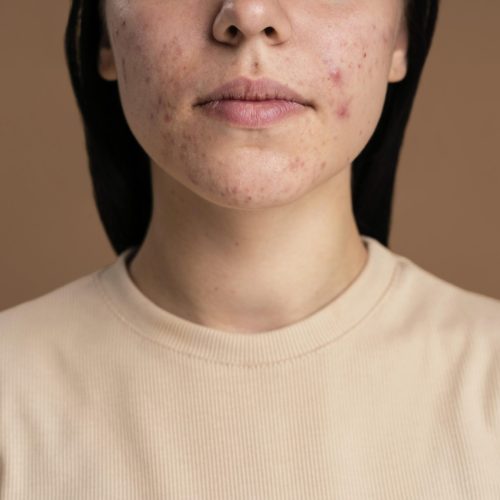 confident-young-woman-with-acne-close-up