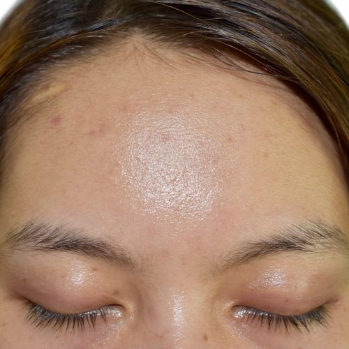 Oily skin with wide forehead of Southeast Asian, Myanmar or Korean adult young woman. Closeup view.