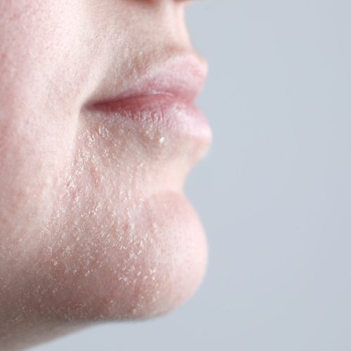 Woman with dry skin on face against light grey background, closeup. Space for text